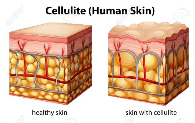 20060151-illustration-of-skin-cross-section-showing-cellulite-stock-photo